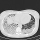 H1N1, atypical pneumonia: CT - Computed tomography